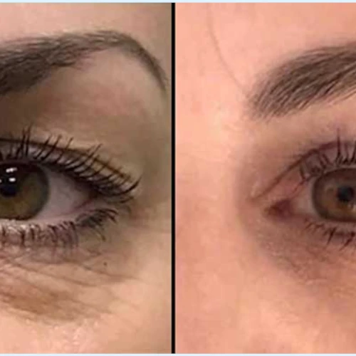 Optocenter | Optika Minus 50 - Blefaroplazma /Blepharopasma